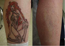 Janssen Pico/Q-Switched ND YAG Laser Tattoo Removal