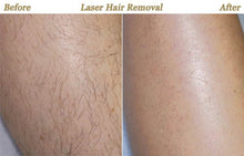 Janssen Triple Wave Diode Hair Removal Laser