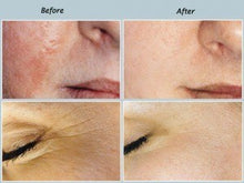 Janssen Hydra Dermabrasion & Oxygen Infusion